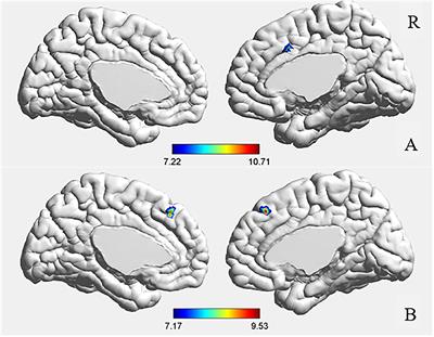 Comparative Study on the Functional Connectivity of Amygdala and Hippocampal Neural Circuits in Patients With First-Episode Schizophrenia and Other High-Risk Populations
